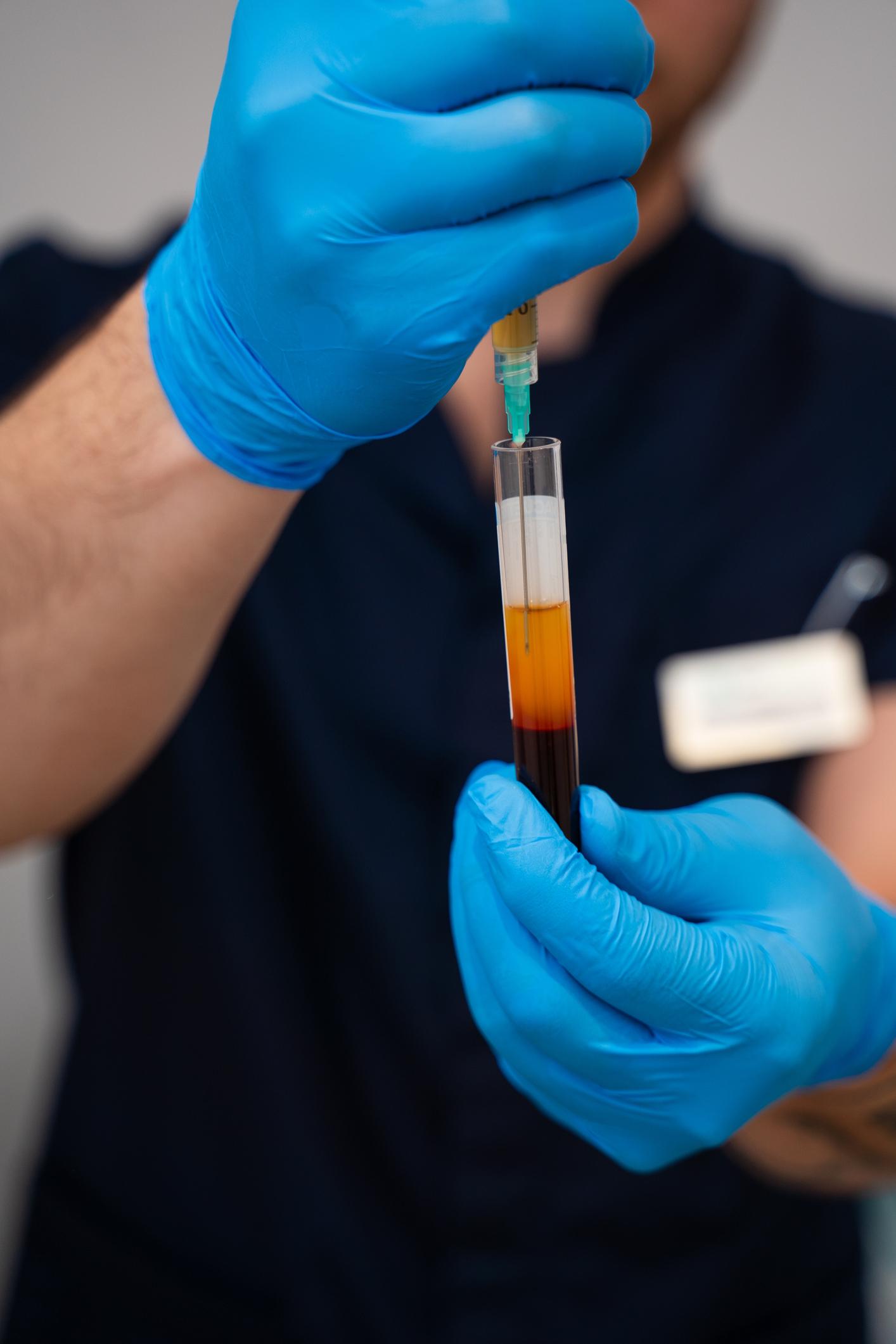 Advanced Platelet-Rich Plasma (PRP) Therapy for Smell Loss