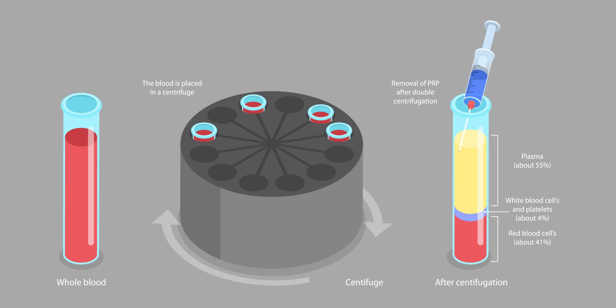 PRP therapy preparation and procedure